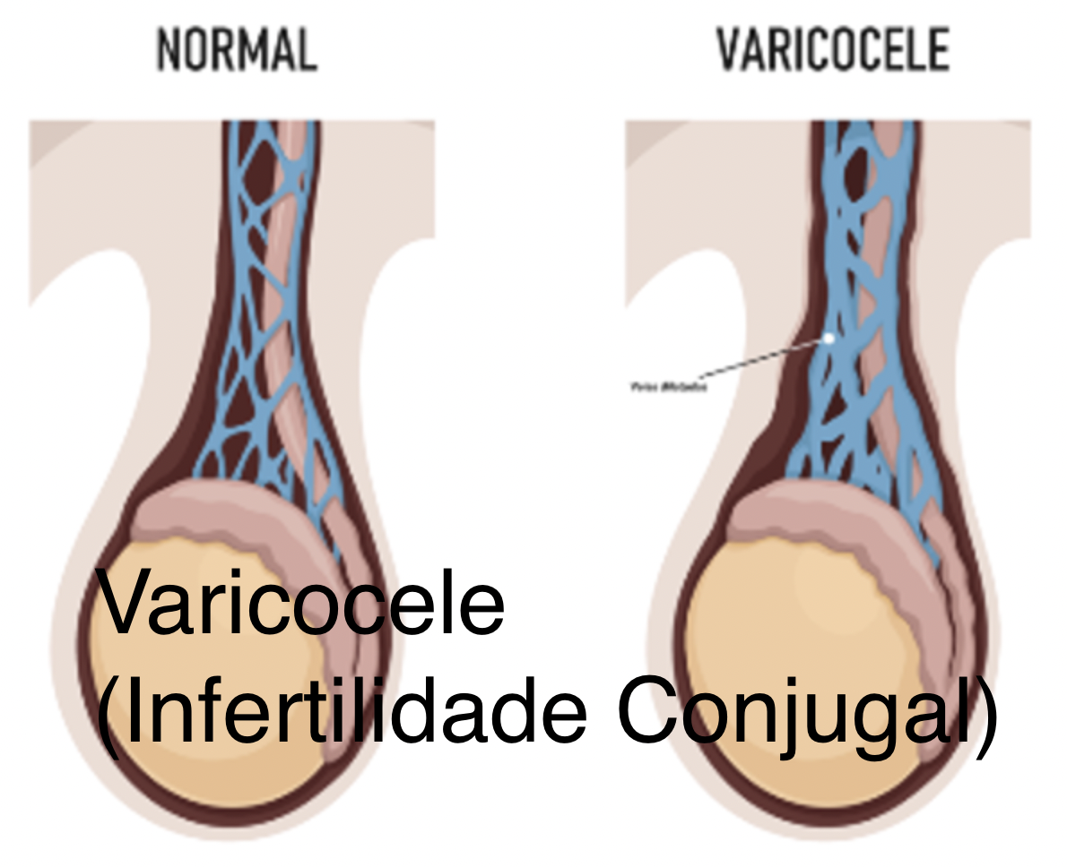 Read more about the article Infertilidade Conjugal (varicocele)