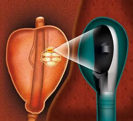 Ilustração do HIFU: ultrassom focalizado tratando o câncer de próstata